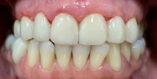 Veneers After