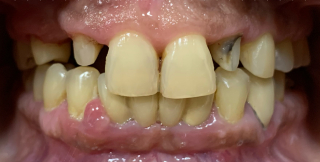 Crown - Zirconia Before