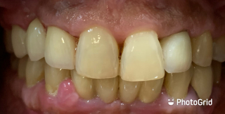 Crown - Zirconia After