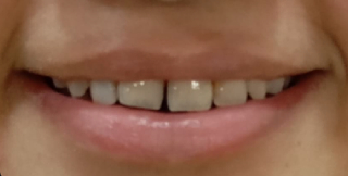 Diastema Closure Before