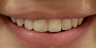Diastema Closure After