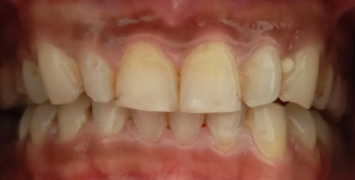 Teeth Whitening Before