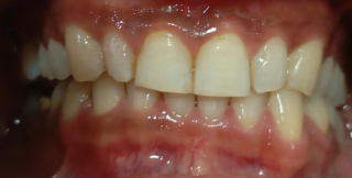 Teeth Whitening After
