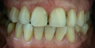 Veneers Before